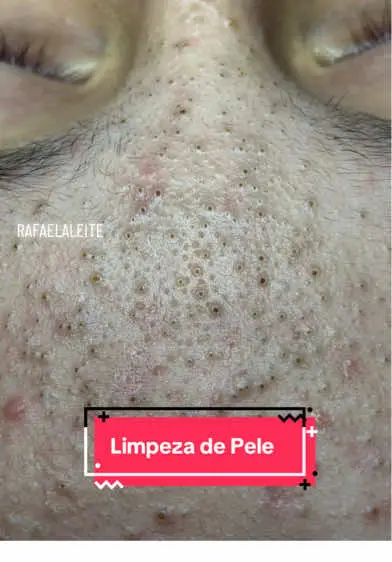 🧼✨ A importância da limpeza de pele Hoje realizamos uma limpeza de pele profunda no nosso cliente de 12 anos, focando especialmente na remoção de cravos. Esse procedimento é essencial para manter os poros limpos, evitar inflamações e prevenir o surgimento de espinhas. Mas lembre-se: cuidar da pele não é só sobre o que fazemos por fora! 🌱 Para quem tem tendência a cravos e espinhas, uma boa alimentação faz toda a diferença. Alimentos ricos em açúcar e derivados do leite podem causar inflamações na pele, piorando o quadro. 🥛🍫 🌟 Dicas importantes: 	•	Diminua o consumo de doces e produtos lácteos. 	•	Invista em frutas, legumes e alimentos ricos em antioxidantes. 	•	E, claro, mantenha sua rotina de cuidados em dia com a ajuda de um profissional. A pele saudável começa de dentro pra fora e com os cuidados certos! 💆‍♀️✨ Gostou das dicas? Salve este post e compartilhe com quem precisa saber! 💖 #limpezadepeleprofunda #limpezadepele #cravos #espinha #extracaodecravos #limp #limpezadepele #videoviral #fyyyyyyyyyyyyyyyy 