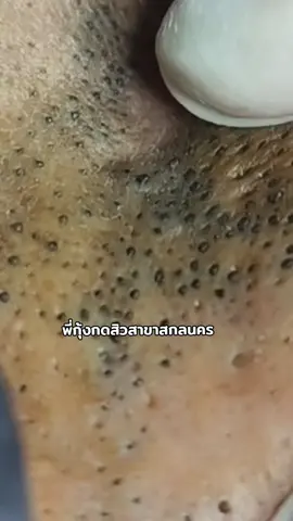 #พี่กุ้งกดสิว #ลูกศิษย์พี่กุ้งกดสิว #ลูกศิษย์พี่กุ้งกดสิวสาขาสกลนคร #กดสิวสกลนคร #กดสิวทั่วหน้า #สิว #สิวหัวดํา #สิวอุดตัน #สกลนคร 