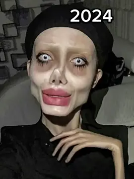 #fyp #plasticsurgerygonewrong #foryoupage 