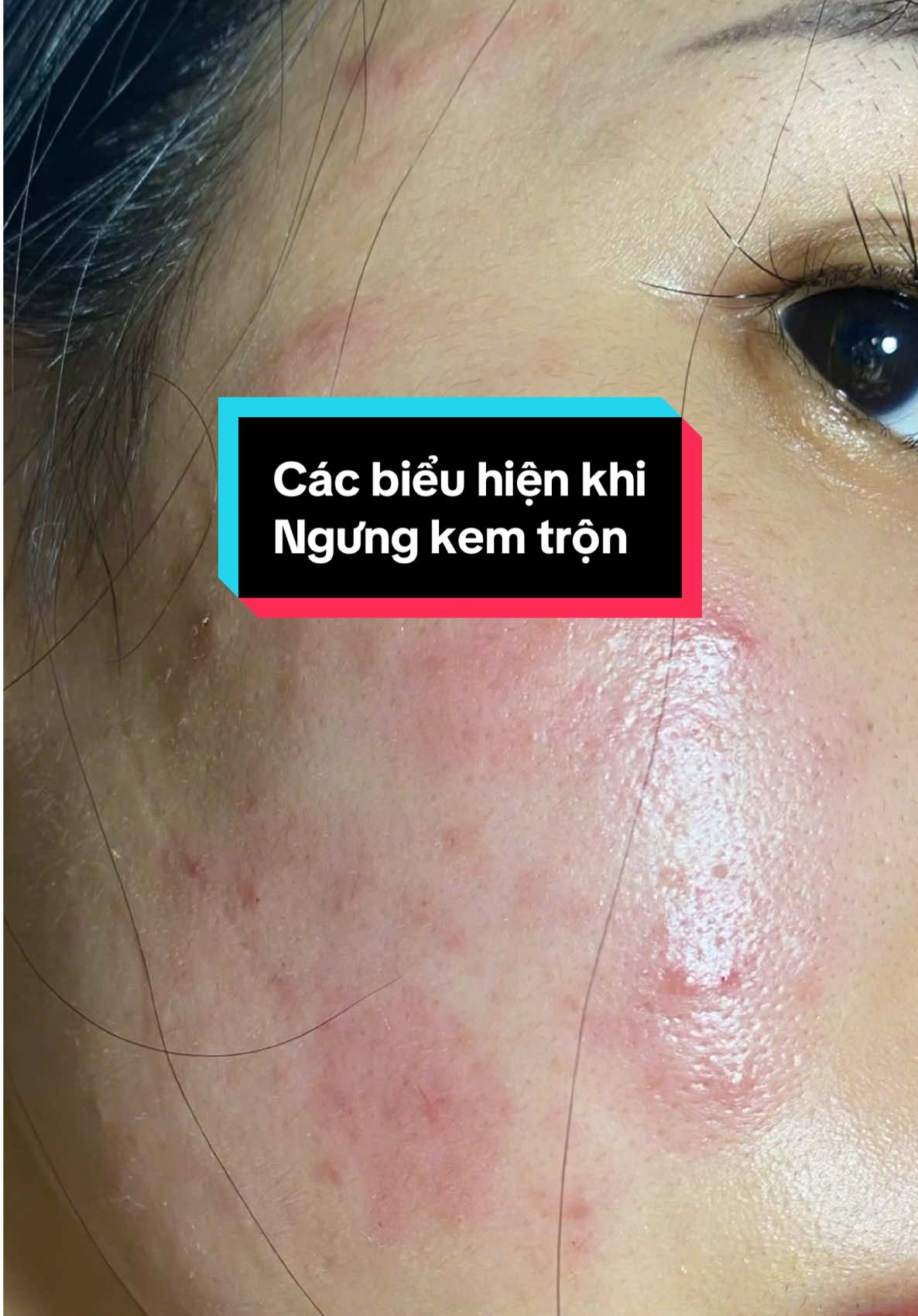 Những ai đang dùng kem trộn hay rượu thuốc thì nên biết. #skincare #skincareroutine #phụchồida #kemtron 