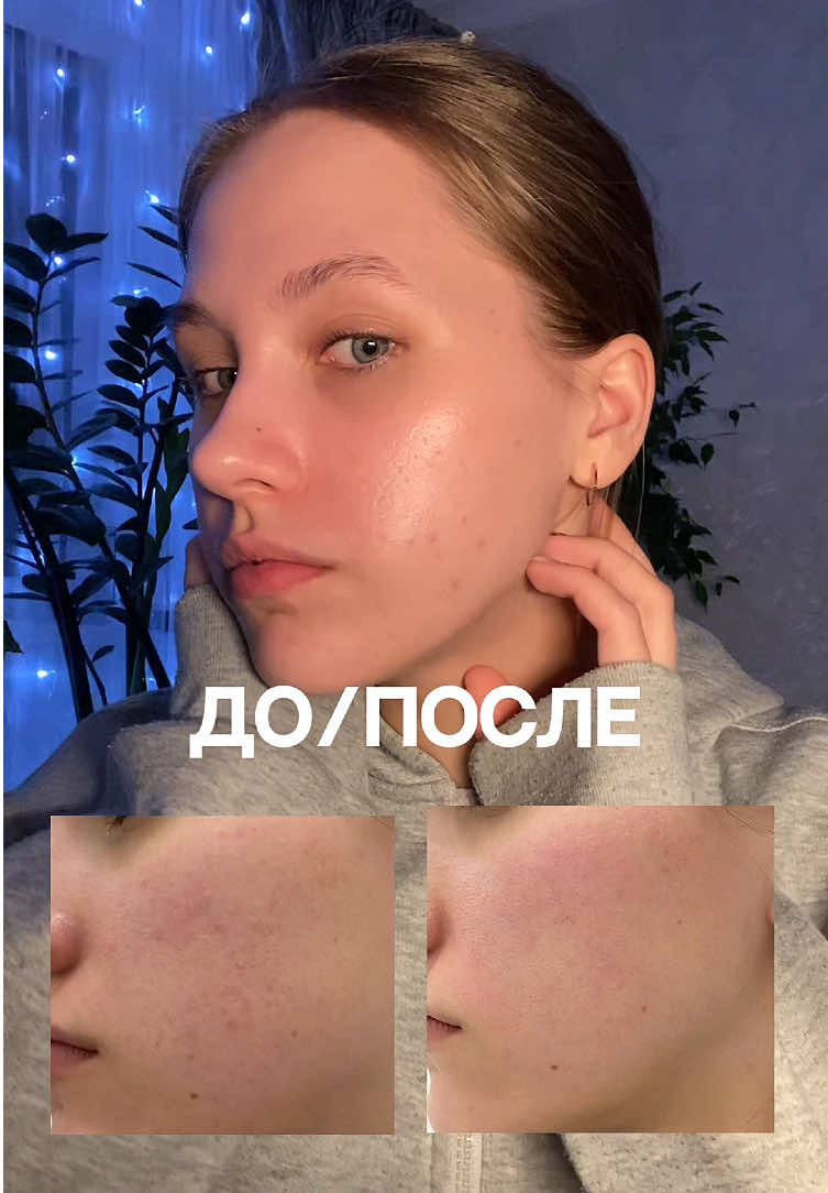 Лучшие! @Уходовая косметика MASSTIGE 💖 #masstige #обзор #уходоваякосметика #акне #проблемнаякожа #вечерняярутина #уходзалицом #сывороткадлялица #допосле #обзорпокупок #мила 