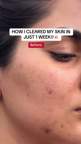 EASIEST WAY TO CLEAR ACNE SCARRING AND ACNE SKIN!✨ #foryoupage #foryou #trending #skin #skincare #clearskin #acne #acneskin #asiangirl #desi 