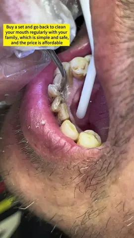 Don't wait until your teeth become like this before you think of me. I recommend everyone to use this household dental cleaner. It doesn't need water. It's simple, safe and effective to use directly. It's also cost-effective to clean your teeth regularly. #oralcavity #oralhygiene#demtalstain#nbgrlvs#tiktokshop#tiktok#foryou #TikTokShopSummerSale #DealsForYouDays #falldealsforyou #halloweensale#freeshipping#flashsale#shopnow#linkinbio