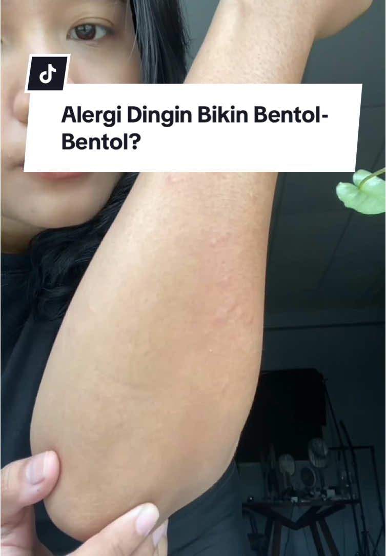 Siapa disini yang setiap dingin pasti kulitnya bentol-bentol atau yang biasa disebut biduran?  Iya, biduran atau bentol-bentol sering banget dialami sama orang di musim dingin atau musim hujan yang biasanya karena alergi atau gigitan serangga. Kalian ada yang sering ngalamin biduran juga? #gatalgatal #alergi #alergikulit #biduran #serangga #gigitannyamuk #raketnyamuk #raketnyamuk2in1 #raketnyamukrecharge #raketnyamukelektrik #obatnyamuk 