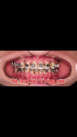 Bẻ loop kéo 4 răng cửa giảm Hô, đóng khe thưa cùng Nha Khoa S - Dental    #keẻoangthuanhuthenao #maccaisua , #niengrang  #helix,  #cackeurangcannieng #niengrangsau #niengrangsu #minivis, #mấtrăngsố3cóniềngđượck, #facmask, #rănglệch, #cáclưuýkhiniềngrăng , #cắmminivisniềngrăng 