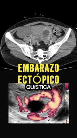 Explicación ✅⬇️:  Este es un caso clínico de la literatura y tiene un punto para criticar: * Con el ultrasonido y la imagen en anillo de fuego, el líquido libre abdominal y la hipotensión era suficiente para hacer el diagnóstico de embarazo ectópico + probablemente roto. Aún así considero que es un caso muy educativo para exponer hemoperitoneo ( Sangrado en cavidad peritoneal). Un embarazo ectópico ocurre cuando el embrión se implanta fuera del útero, generalmente en las trompas de Falopio. Si este embarazo crece y no se detecta a tiempo, puede romperse, causando un embarazo ectópico roto. Esto provoca sangrado interno severo, un cuadro grave que pone en peligro la vida. Los síntomas incluyen dolor abdominal intenso, mareo, desmayos y sangrado vaginal. Es una emergencia médica que requiere atención inmediata. Detectarlo temprano puede salvar vidas. 🚨 #salud #radiology #ginecología #Obstetricia #embarazo