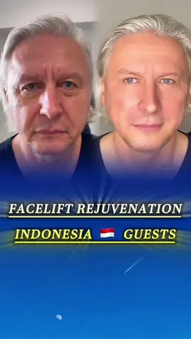 Full facelift for men by Dr. Jong. #facelift #rejuvenation #surgery #tiktokmalaysia #kualalumpur #malaysia #drjong 