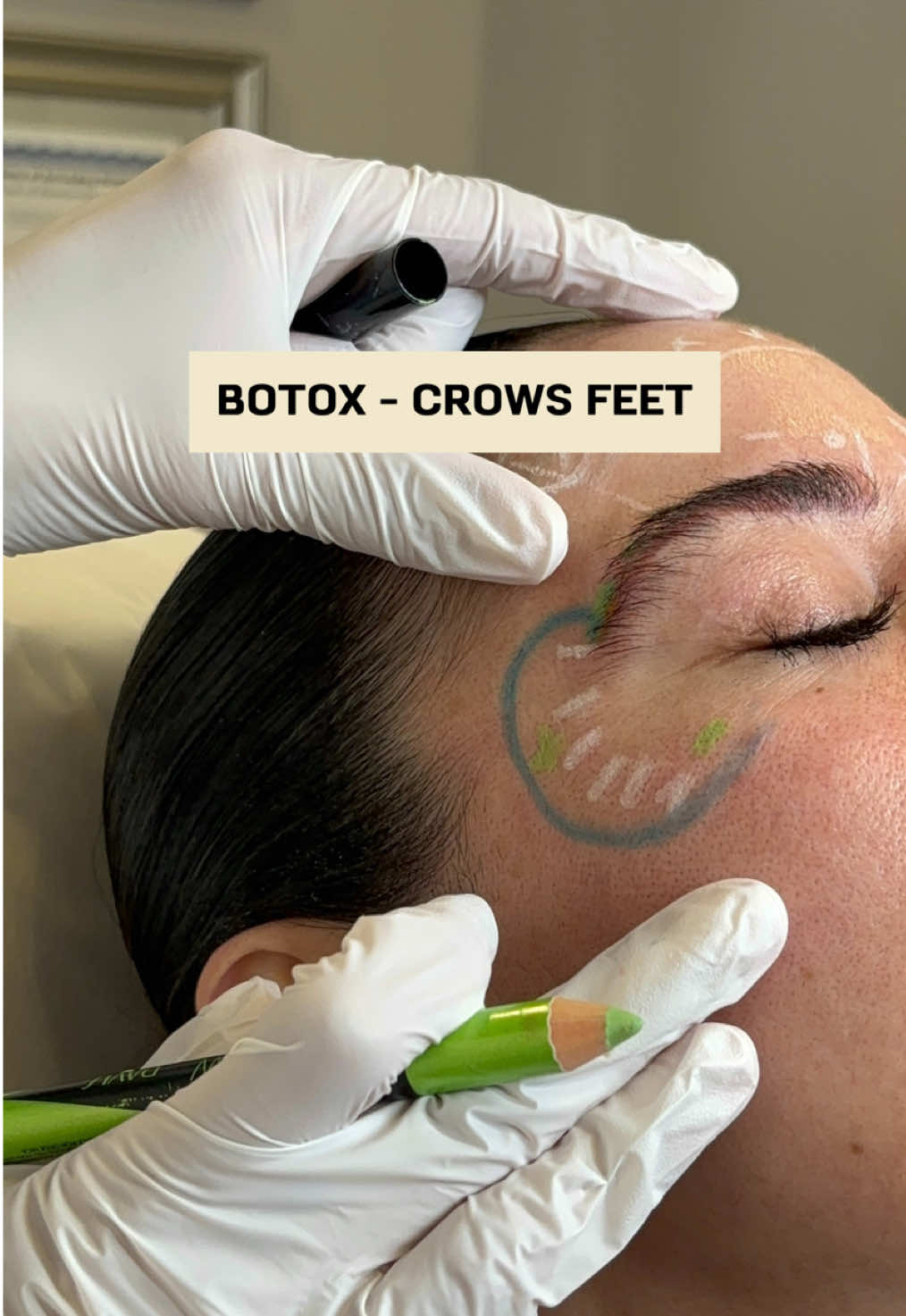 Say goodbye to those fine lines around your eyes! 👋✨ Botox is the perfect solution to smooth out crow’s feet and refresh your look. #BotoxCrowsFeet #AntiAgingTreatment #SmoothSkinGoals 