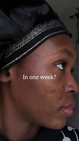 Stay consistent and use the right product 🥰🌟  Get the ANUA Dark Spot Correcting Serum @MLA |Korean Skincare in Africa now!! #anua #mylabafrica #MLA #anuatxaserum #glow #pigmentation #brightening #kbeauty #koreanskincare #babyskin #pores #bouncyskin #skincare #skintok #fyp #foryou #darkspot