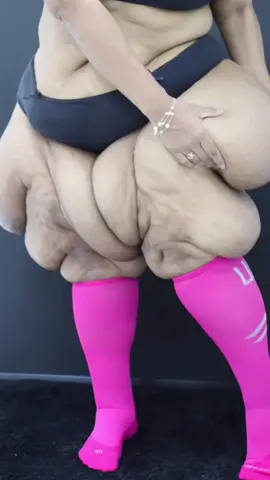 E esse antes e depois ? Eu amooooo minhas perninhas novas 🥹♥️ 31kg de lipedema a menos 🙏🏽 #antesedepois #lipedema #cirurgia 