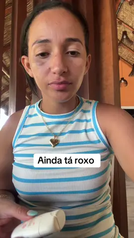 Ainda tá roxo #registrodevida 