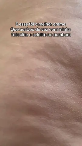 O trem e tão bom que diminuiu até o meu a medida dos meus buquinis 😭😭 terei que comprar novos biquínis para o verao #lipedema #celulite #foliculite #flacidez #estrias 