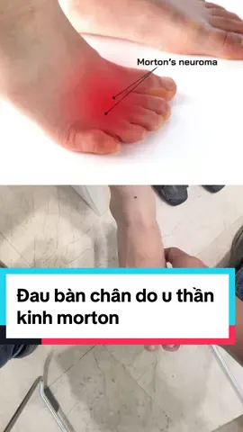 Đau bàn chân do u thần kinh morton #daubanchan #morton #benhvienchanthuongchinhhinh #khopvietofficial #bacsichanthuongchinhhinh #bsnguyenviettan #bscoxuonhkhop @BS.CK2. Nguyễn Viết Tân 