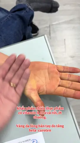 Vàng da lòng bàn tay do tăng beta-caroten