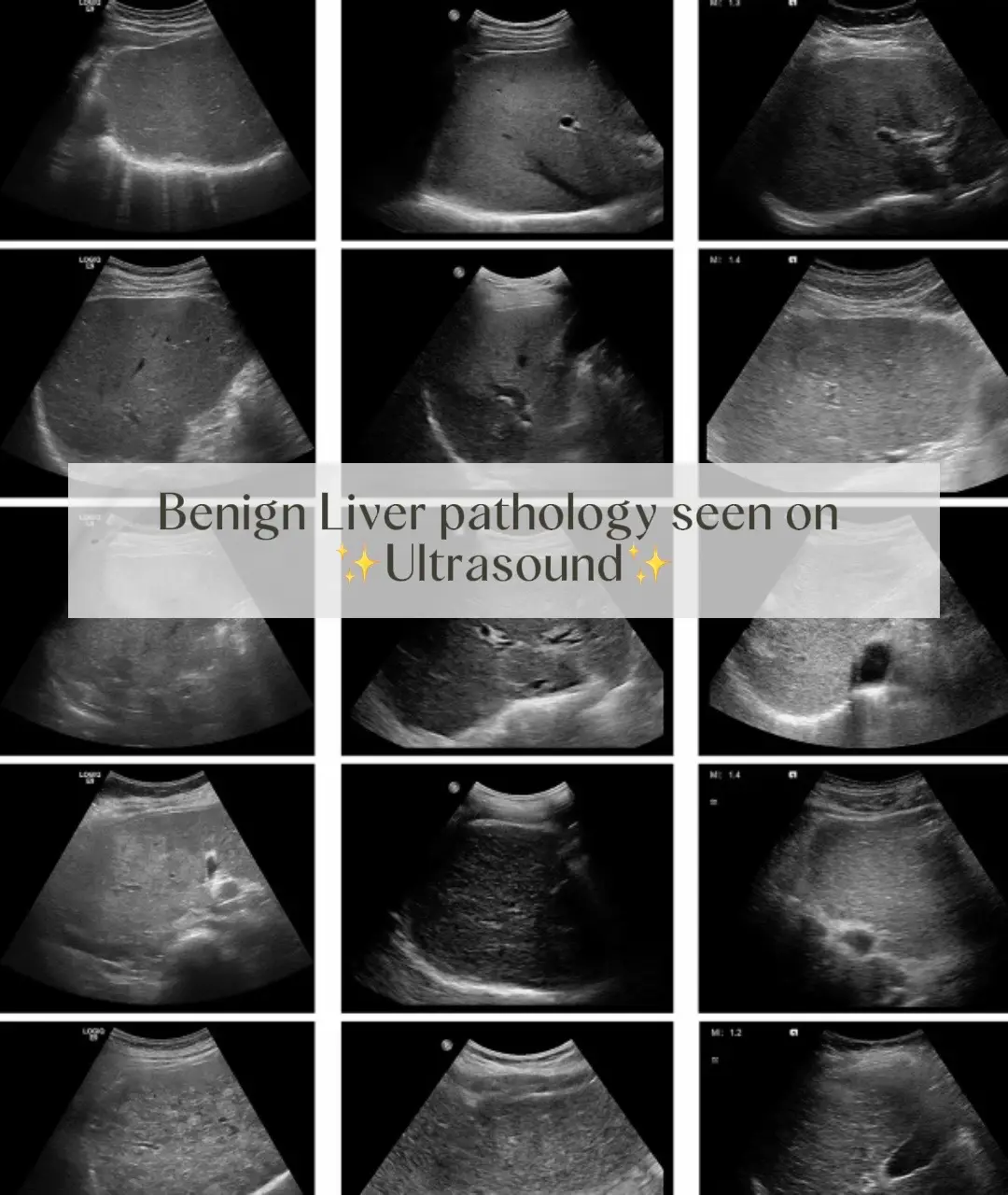 Love me some liver pathology🤩  #radiologylife #fyp #sonogram #sonography #sonographer #ultrasoundlife #ultrasoundlife #ustech #medicalfield #dayinmylife #ultrasound #sonographercheck #sonographersdoitinthedark #ultrasoundtech #ultrasoundtechnologist #pathology #liver #healthcare #health #Lifestyle #life #everyday #fypシ #Love #career 