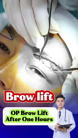 Pengangkatan alis membantu menghilangkan kelebihan kulit dari area mata #fyp #fypシ #viral #facelift #operasi #eyelid #browlift #indonesia #dokternguyenkorea 
