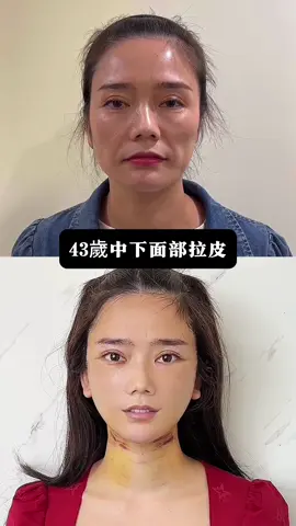 #拉皮 #拉皮手術 #面部提升 #抗衰 #醫美諮詢 #醫美診所 #facelifts #facelifting #facelift #大陸醫美 #plasticsurgreys #faceliftnatural #lowerfacelift #minifacelift #整形 