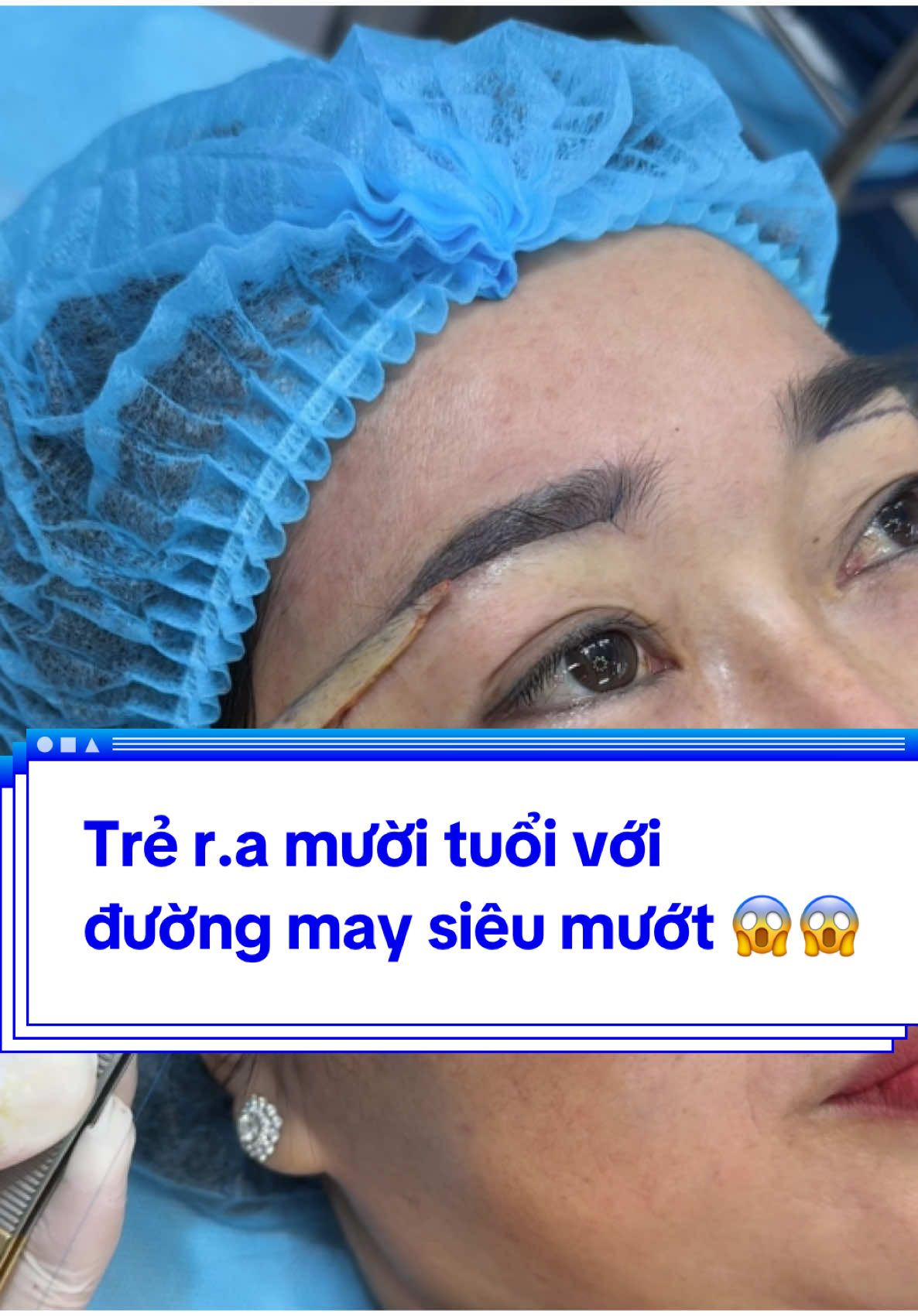 Trẻ r.a mười tuổi với  đường may siêu mướt 😱😱#Tuyết_Diamond #videoviral #xuhuong #Làm_đẹp_an_toàn #Mí_form_tự_nhiên #Khâu_rút_chỉ #Nâng_cung_chân_mày 