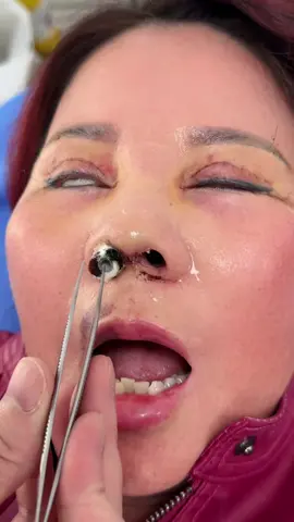 Rút băng mũi có thật sự đau? #drson #operasihidung #nose #Indonesia #Thailand #malaysia #angkathidung #rhinoplasty #cosmeticsurgery #ការលើកច្រមុះ #ការវះកាត់កែសម្ផស្ស