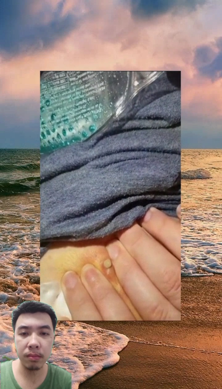 #pimple #Pimple #pimples #pimpleremover #pimplepopper2021 #pimplepopperaddict #pimplepatch #pimpleremoval #pimplepopper2022 #pimples_brufoli #satisfying #Satisfying #satisfyingvideo #satisfyingvideos #satisfyingsounds #satisfyingsound #satisfyingcleans #satisfyingasmr #satisfyingart #satisfyinglips #acne #Acne #acnetreatment #acneskin #acnefighter #acneproneskin #acnescars #acnejourney #acneskincare #acnepatch #Blackhead #blackheads #blackheadsremoval #blackheadsss #blackheadsremover #blackheadsremovalmask #blackheadsextractions #blackheadspopping #blackheadstrip #blackheadsout #blackheadsremove #foryou