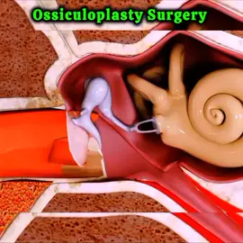 Ossiculoplasty Surgery #doctorstrange #animatedstories #3danimation #surgery #3danimations #3danimation #surgery #animatedstories #doctor #earcare #earhealth #earcare #patientfirst #foryoupage❤️❤️ #videoviral #foryoupage❤️❤️ #videoviral 