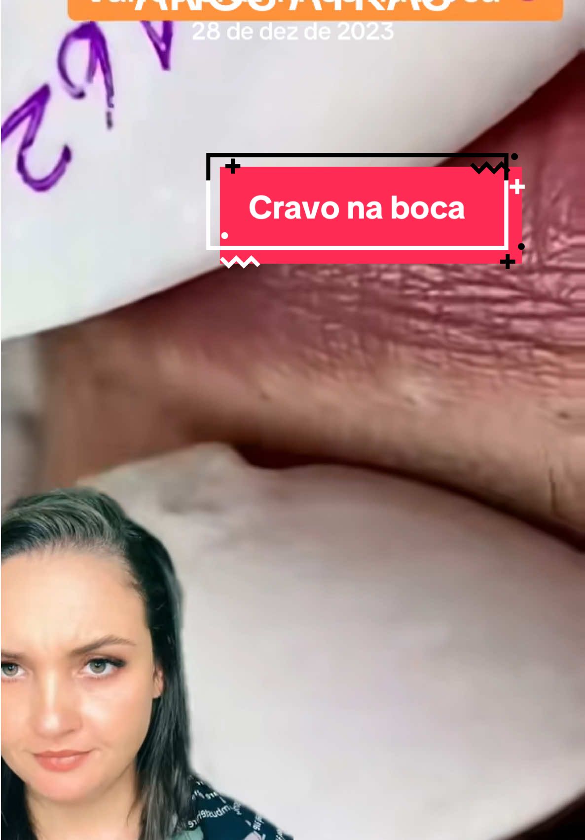 #anosatrás #cravos #terapia #satisfatório #reagindo #limpezasatisfatoria cravo na boca 