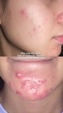 How i get rid of those hormonal acne at home ✨✨✨ @SKINTIFICPH #Skintific #moisturizer #brightening  #skintificmoisturizer #MSHMoisturizer #BrighteningMoisturizer #Pamumula  #Pampaputi #DarkSpots #acnescars #GlassSkin #niacinamide #pinkmoisturize #kbeauty #koreanskincare 