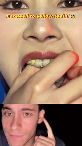 the whitest my teeth have ever been!! #teethcare
#teethwhitening #teethtok #oralhealth #fypage #fy
#toothpaste #teeth 