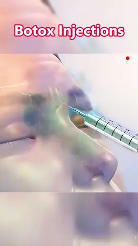 Botox Injections - 3D Medical Animation #botoxinjection #botoxnatural #botox #glabellabotox #browliftbotox #browbotox #botoxforehead #foreheadbotox #facialbalancingfiller #facialbalancing #facialharmonization #GlowUp #chincontouring #cosmeticinjections