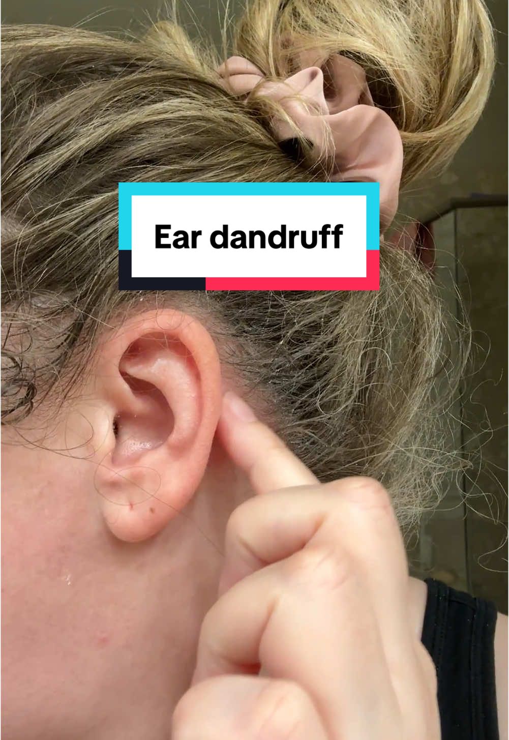 Finally tackling my severe ear dandruff with Roycederm dermatitis cream! Hoping this clears up the flakes and soothes the irritation. Here’s to healthier skin! #DermatitisRelief #SkinCareJourney #Roycederm #HealthySkinTips #FlakeFreeLife #SkinHealing #SelfCareRoutine #NewYearNewAura #TikTokShopHolidayHaul #SkinCareEssentials Roycederm dermatitis cream, ear dandruff relief, severe dandruff solution, dermatitis treatment, flaky skin fix, soothing cream, skin care for ears, seborrheic dermatitis remedy, healthy skin, irritation relief