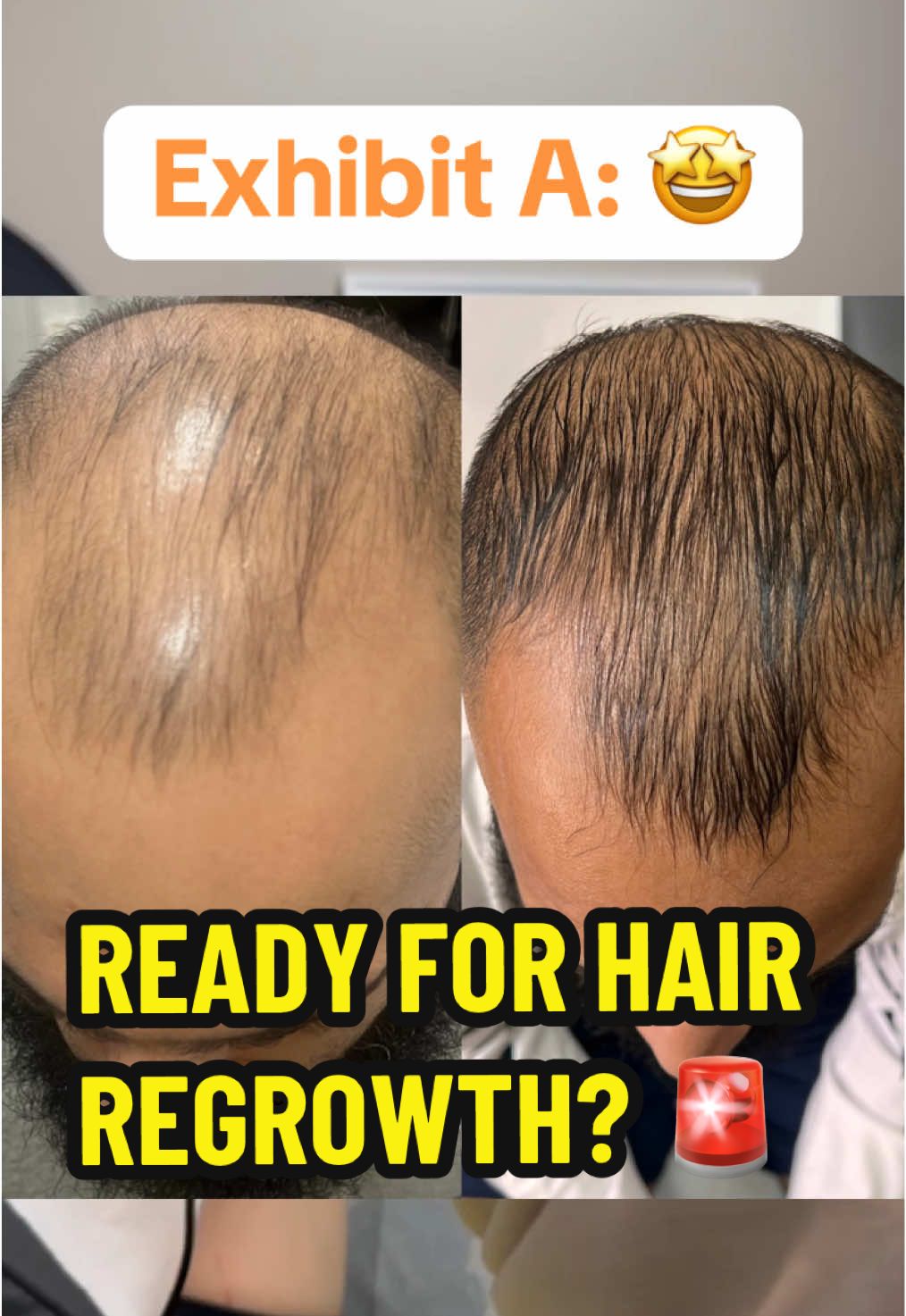Here at Harmony Medical, we use the latest technology to create the BEST results for our patients. Ready for your transformation? #exosomestemcell #exosomes #exosomesbeforeandafter #hairtransformation #hairtransplant #halifax #harleystreet 