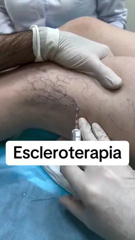 #escleroterapia #estetica #varizes 