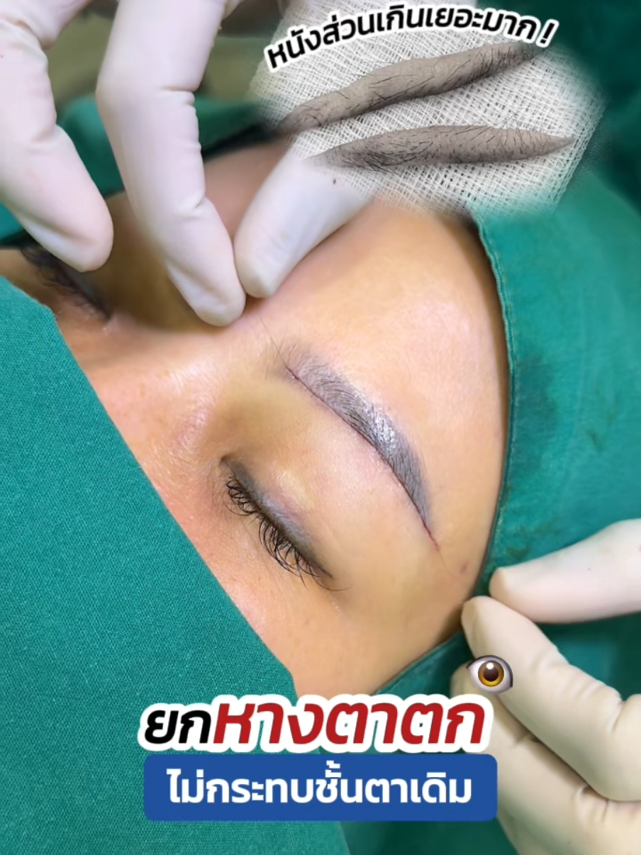 ยกหางตาตก ไม่กระทบชั้นตาเดิม 😲 #ซ่อนแผลใต้คิ้ว #subbrowlift #ซ่อนไหมไร้รอยเข็ม #skyclinic #สกายคลินิก #จักษุแพทย์ #ทําตาที่ไหนดี #คลินิกทําสองชั้น #ทําตาที่ไหนดี #หางตาตก #ยกคิ้ว #รีวิวบิวตี้ 