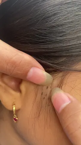 oh listen to the sound 😭😱😬#omg #lice #liceremoval #treanding #for 