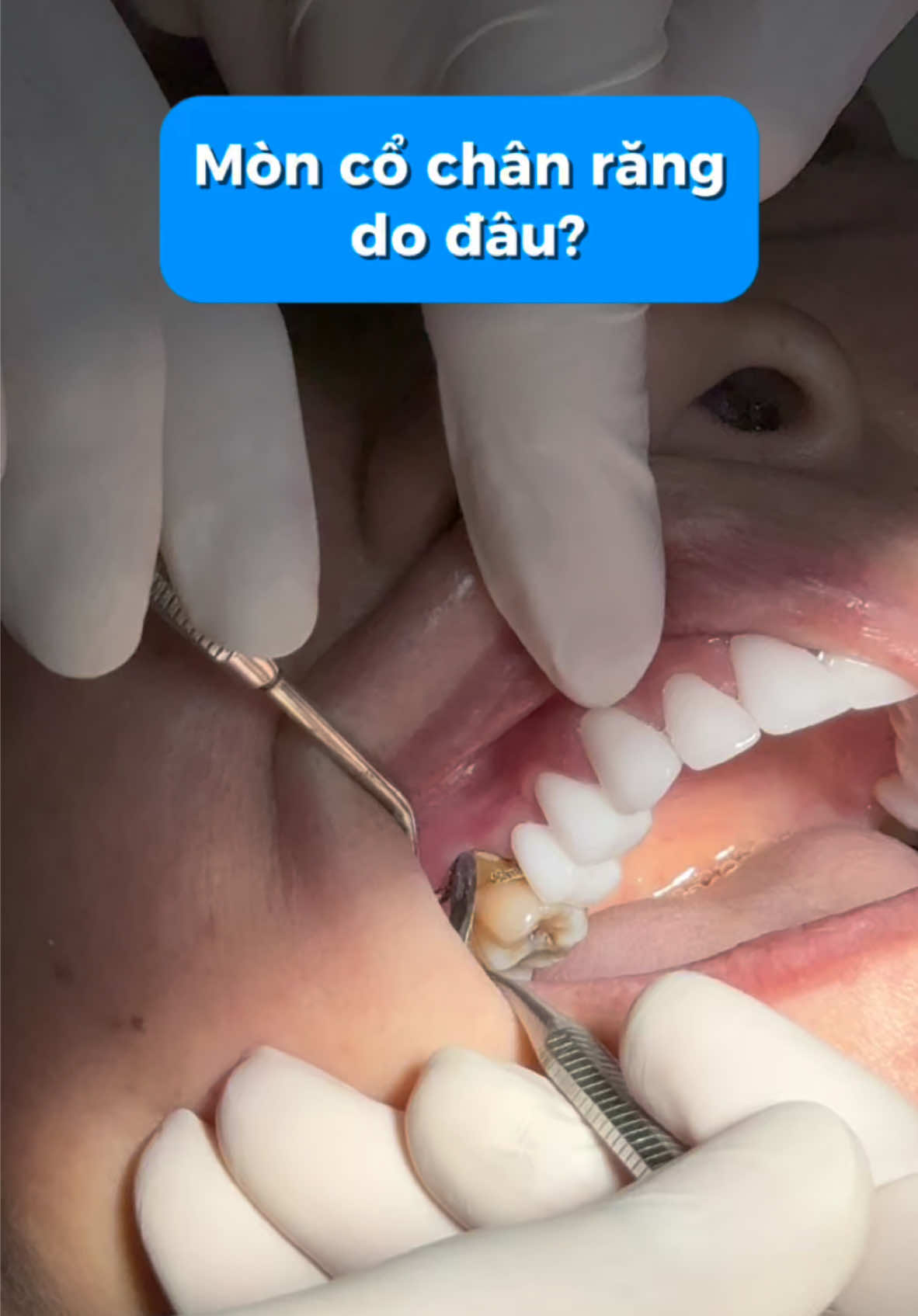 Một sai lầm phổ biến thường dẫn đến mòn cổ chân răng #nhakhoaemedic #mòn_cổ_chân_răng #răng_miệng 