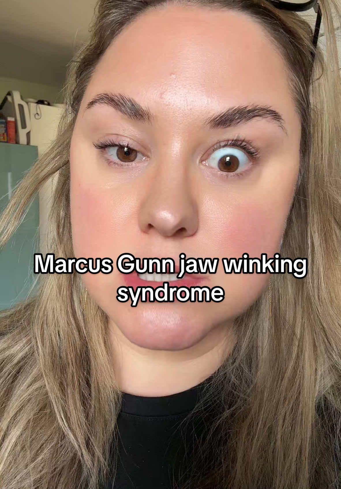 #marcusgunnsyndrome #marcusgunjawwinkingsyndrome #mgjws #chewing #eyelid #jawwinkingsyndrome 