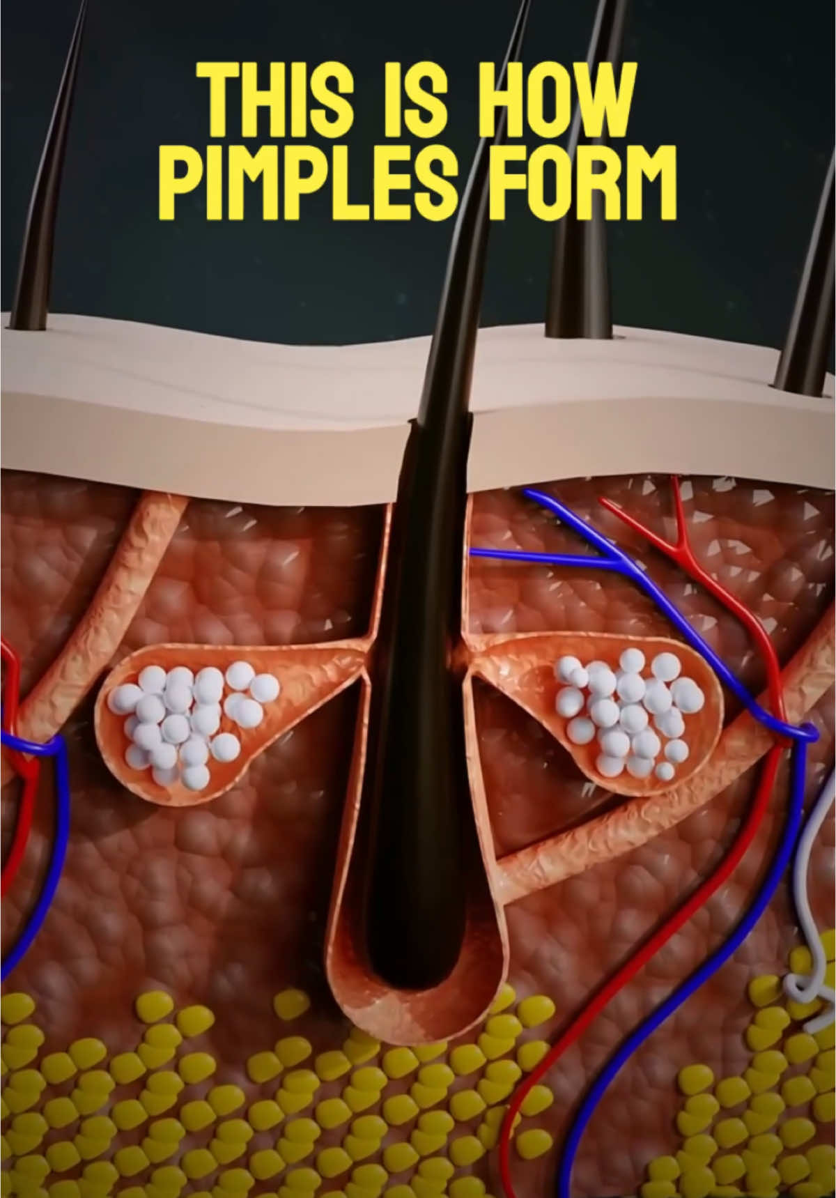 The animation illustrates the process of pimple formation on the skin. It begins by showing pores and sebaceous glands that produce sebum, a natural oil that hydrates the skin and helps remove dead cells. When excess sebum and dead cells are produced, the pores become clogged, creating an ideal environment for the Propionibacterium acnes bacteria. This bacteria feeds on the accumulated sebum, leading to an infection. The immune system responds by sending white blood cells, causing inflammation, and red blood cells, which create redness - and that's how pimples form. 