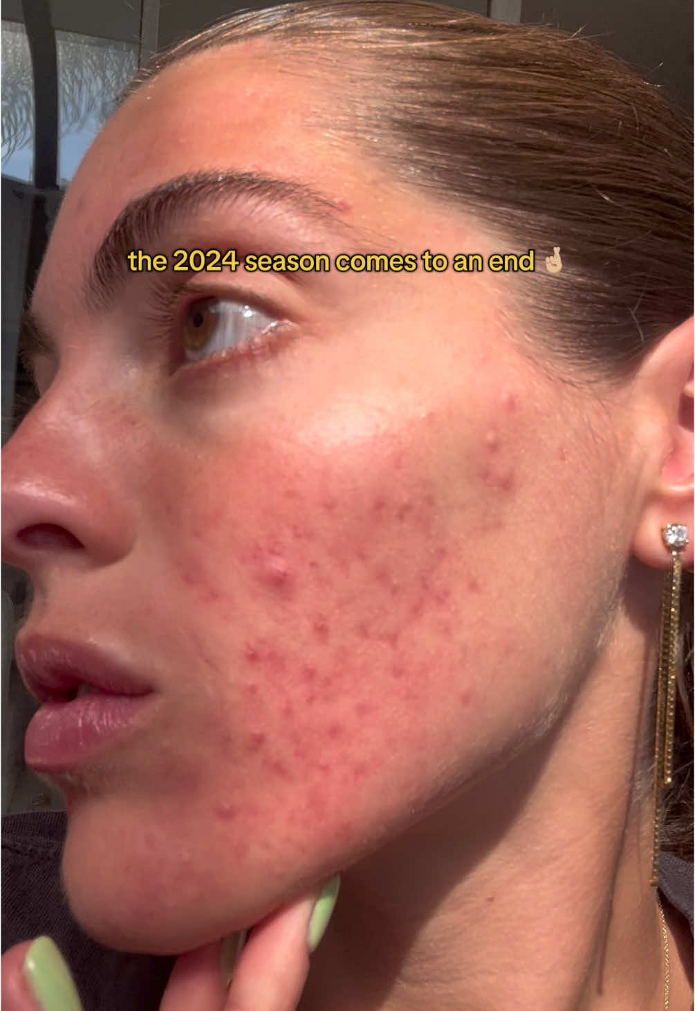 Some days I still can’t believe that ACNE opened this can of (amazing) worms 🐛 for me!!! 💘❤️‍🩹 here’s to 2025 🤞🏼 🥂 #fyp #acnejourney #skinfluencer #acne #adultacne #skinjourney #healing #accutane #accutanejourney #newyears #2024recap 