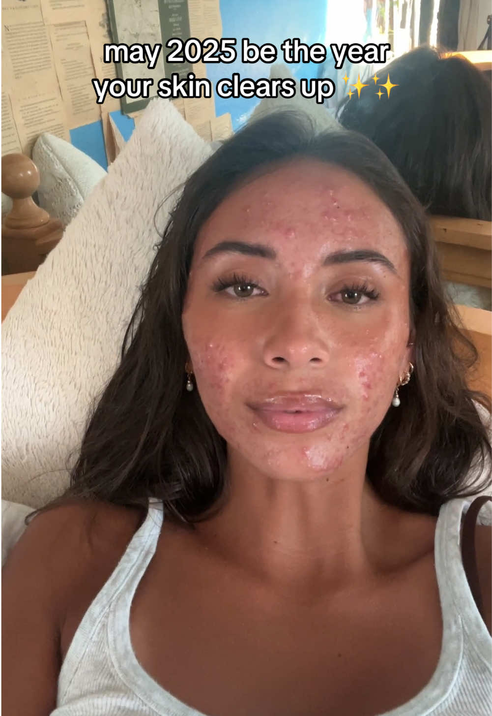 manifesting good skin for the new year!! 🌟🌟 highlight of 2024 was clearing this up 🤗 #acne #acnejourney #newyear #fyp #skin 