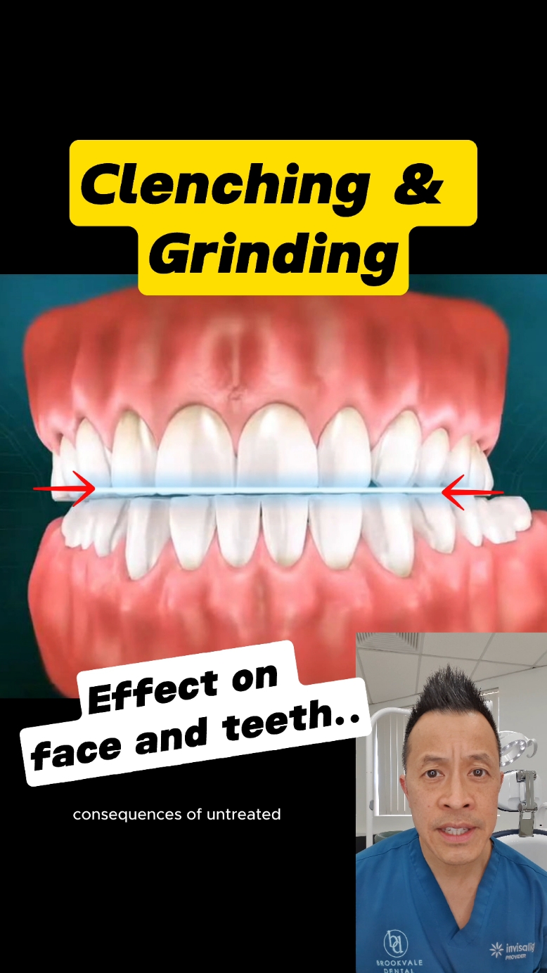 Teeth Grinding: How It Changes Your Smile and Face Shape #dentallan #dentist #bruxism #grinding #clenching #teethgrinding #teethclenching #faceshape #worndownteeth #squarejaw 