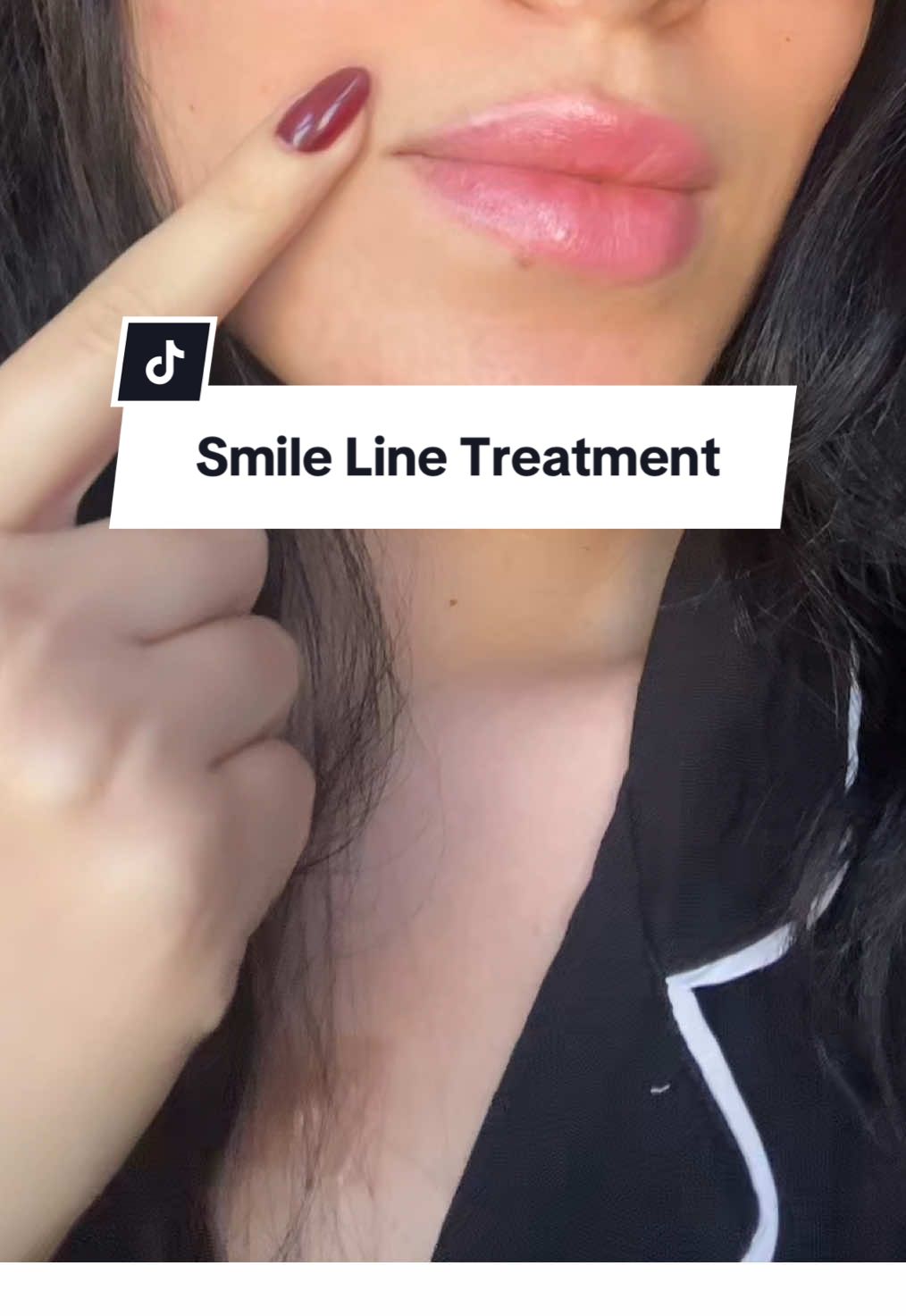 It really works #siliconescarsheets #siliconescartape #scartapeforwrinkles #smilelines #smilelineshacks #smilelinestreatment #wrinkleprevention #scartape 