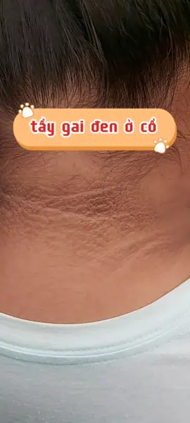 tẩy gai đen ở cổ#ruashops6 #taytebaochet #lamdep #lamdeptainha #xuhuong #xuhuongtiktok 