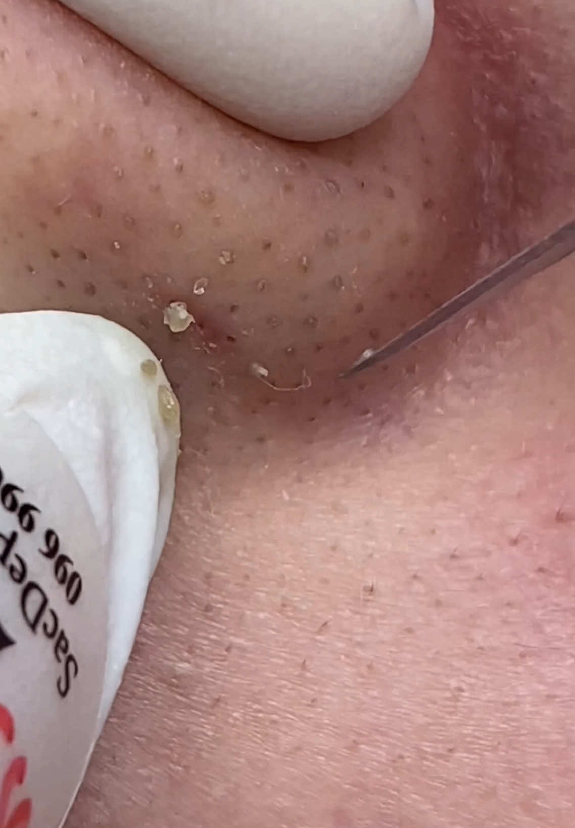 Cánh mũi hơi đen, cùng làm sạch thôi nào #sacdepspa #thuytruong #pimple #acne #nanmunbangtay 