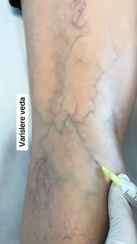 İzlemesi asiri keyifli seylerde bugun #varisu #sclerotherapy #operation 