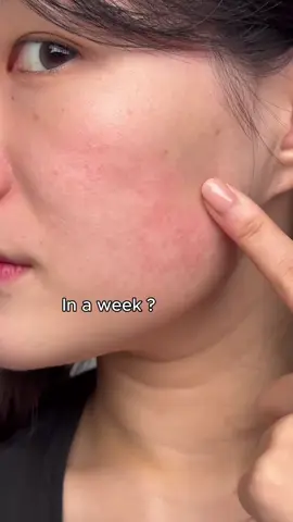 Niacinamide whitening soap can not only remove mites and acne, but also whiten the skin. Sisters who have not used it must try it#turmericandkojicacidsoap #clarifyingsoap #turmericsoap#turmericskincare #skincare #kojicacidsoap #brighteningbar#brighteningbarsoap #soap #darkspots #acnescars#hyperpigmentation #type #foryou #pypage*/#tiktokshop#hyperpigmentation #armpits #darkarmpits##VGO#vgobeauty#TikTokShop 