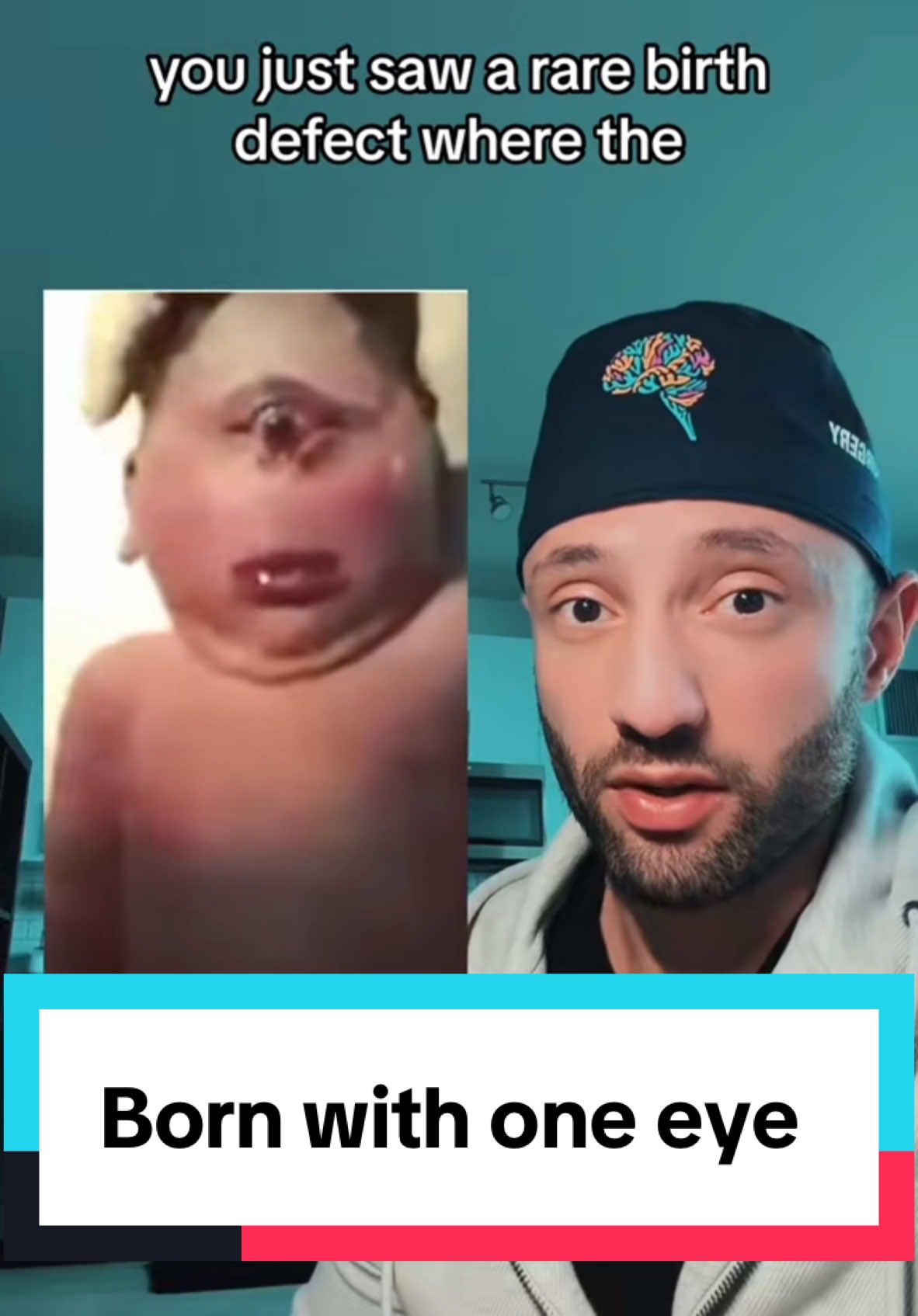 Child born with a conjoined eye. #medical #doctor #medtok #rare #pregnancy #onthisday 