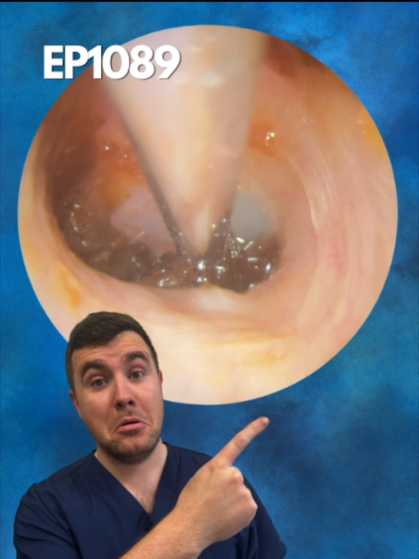 Deep, Stubborn Ear Wax Finally Removed – So Satisfying to Watch! - EP1089 Thank you for watching our ear wax removal video today. The ear wax extraction featured in todays video was carried out using endoscopic microsuction. This procedure uses a small camera called an endoscope to visualise inside the ear canal whilst a small suction tube is inserted to gently remove ear wax.   All the ear wax cleaning videos you see on our channel are carried out by our ear wax specialists Mr Rhys Barber and Mr Taylor Green.  Want to book an appointment? Check out our link tree: https://tr.ee/T7sSZnpw9z  Affiliate Link to Olive Oil: https://geni.us/uIvcrP Affiliate Link to Sodium Bicarbonate: https://geni.us/k7UHke  We post new ear cleaning videos Monday - Friday at 9PM GMT so if you find ear wax removal satisfying please consider subscribing to our channel.  Ear wax plays a vital role in ear health. It helps to prevent ear infection and helps with ear cleaning by picking up any dirt or debris that accumulates in the ear canal. Normally this ear wax would fall out of the ear taking any dirt or debris with it.   How to remove ear wax?   Many people use q-tips/cotton buds for ear wax removal at home this is one of the worst things you can put into the ear as this can lead to an increased ear wax buildup or in extreme cases impacted ear wax. The best way to remove ear wax is to let your ears clean themselves and not to put anything smaller than your elbow in your ears!  How do I know if I have an earwax blockage?  If you experience a change in your hearing, discomfort in the ear or jaw or a feeling of fullness in the ear canal you may have an ear wax blockage. Our advice is to speak to your Doctor or local Audiologist who can take a look in your ears and assess whether ear cleaning is needed.  To arrange an ear wax removal appointment please visit our website:   https://www.audiologyassociates.co.uk  #audiologyassociates #earwax #earwaxremoval #earcleaning