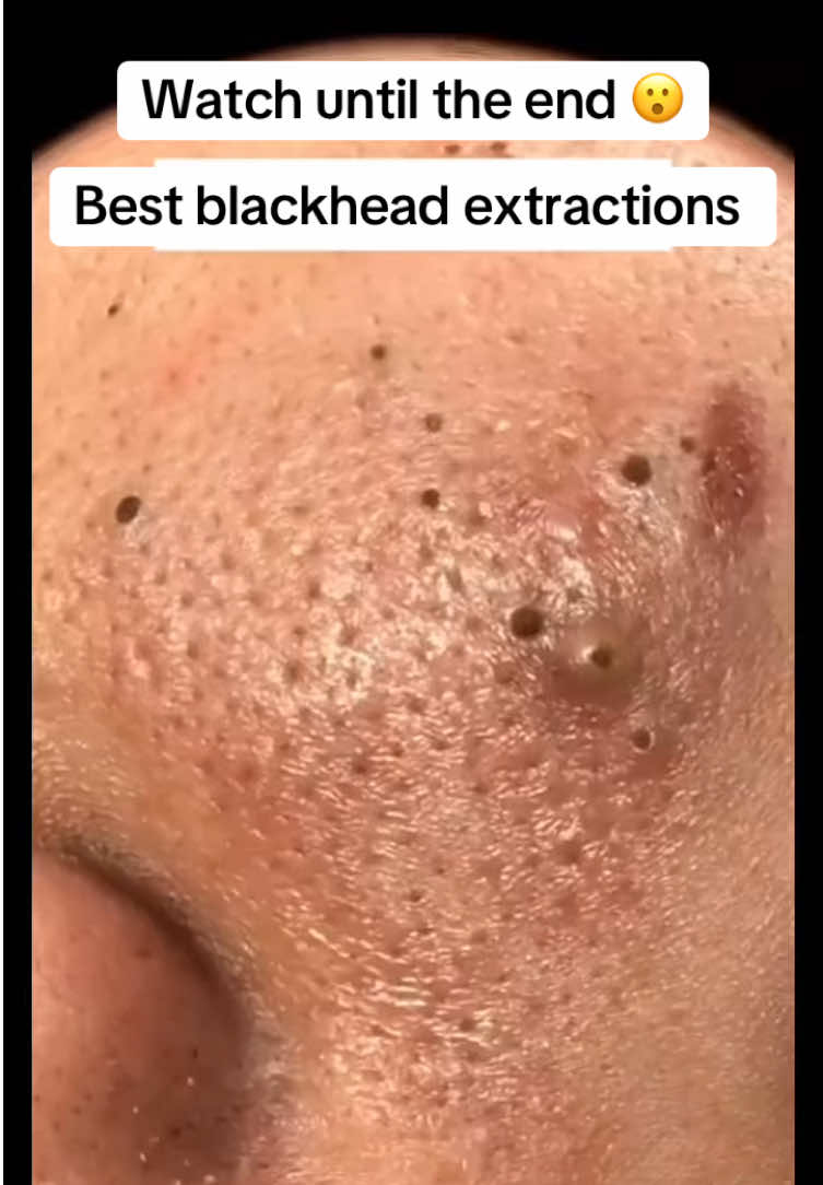 #BlackheadExtraction #BlackheadRemoval #Blackheads #PimplePopper #AcneTreatment #SkinCareRoutine #ClearSkin #AcneSolutions #SkinCareAddict #BlackheadExtractor #PoreCleaning #DeepCleansing #ExtractionTools #SkinExtraction #FacialExtraction #SkincareTools #PoreUnclogging #SkinCareTips #SkinCareLover #FaceCare #HealthySkin #GlowingSkin #CleanSkin #SkinHealth #FaceCleaning #OddlySatisfying #SatisfyingVideo #SatisfyingSkincare #RelaxingSkincare #SkinCareASMR #BlackheadSatisfying #DrPimplePopper #BlackheadVideos #SkincareTikTok #BlackheadChallenge #ViralSkincare #AcneRemoval