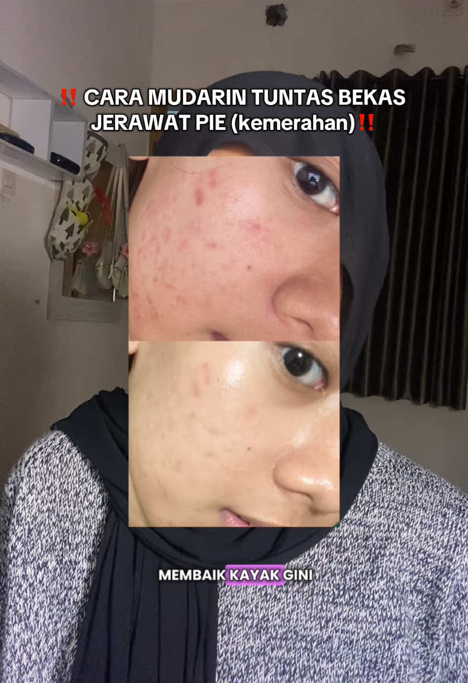 Membalas @t! NO ENDORSE SAMA SEKALI. aku spill smua produknya yg bkin bekas jerawat PIE aku bener2 mudar. inti dari mudarin PIE tuh sebenarnya simple bgt fokus hidrasi dan calming. Untuk lbh lengkapnya tonton aja video aku sampe habis ya bub💓🫶🏻 #PIE #bekasjerawat