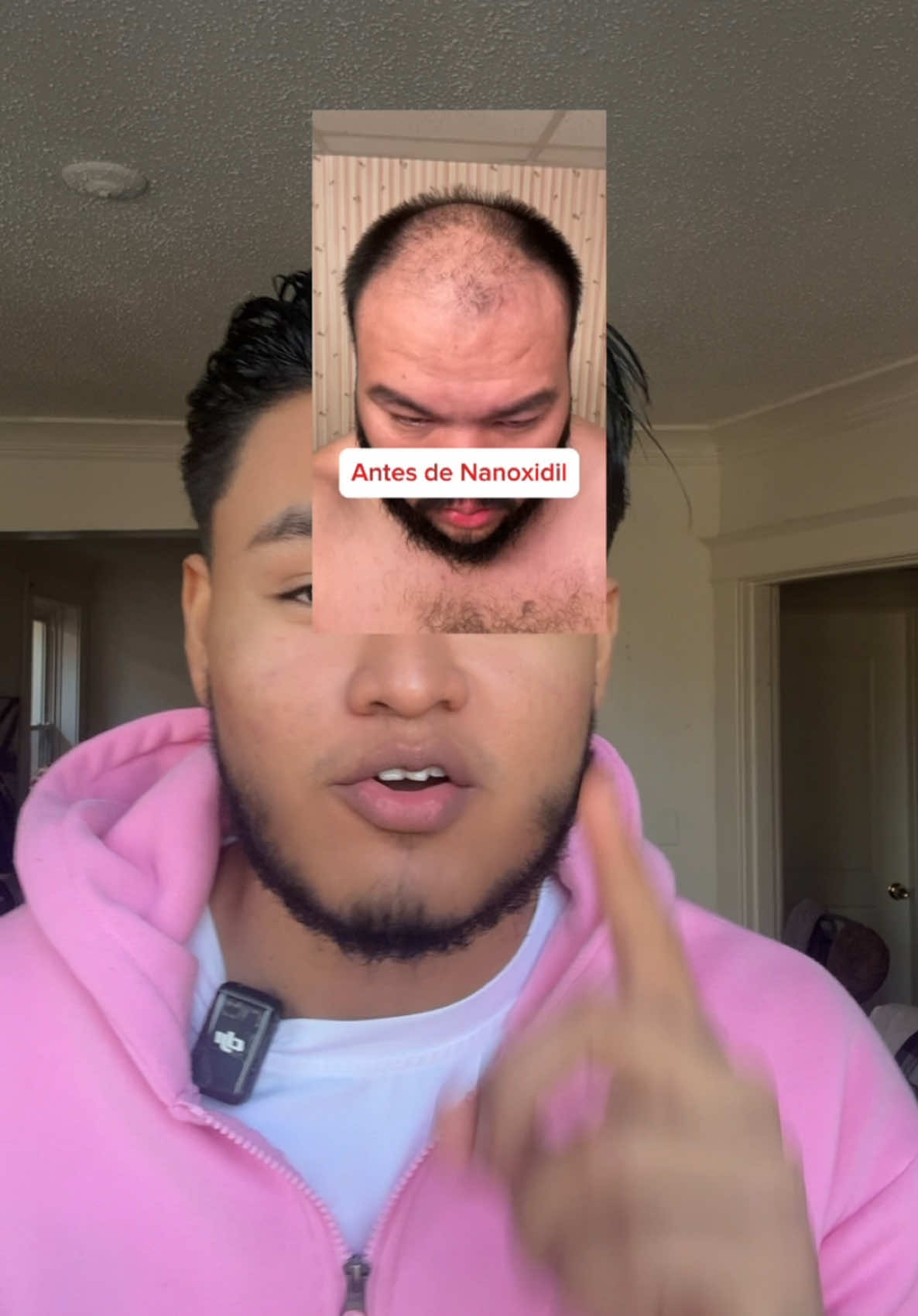 Crecimiento del cabello #haitlosssolutions #alopecia #hairlossremedy #hairgrowth #haircare #hairproducts #hairgoals #hairtransformation #crecimientodelcabello #cabellolargo 